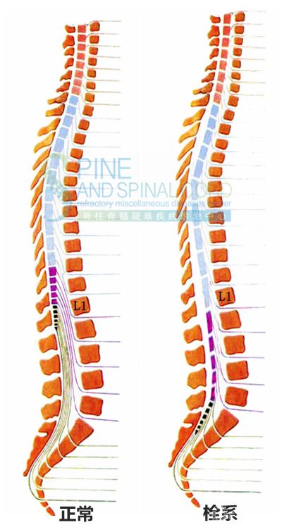 脊髓栓系综合征的发病分期和脊柱外科治疗策略