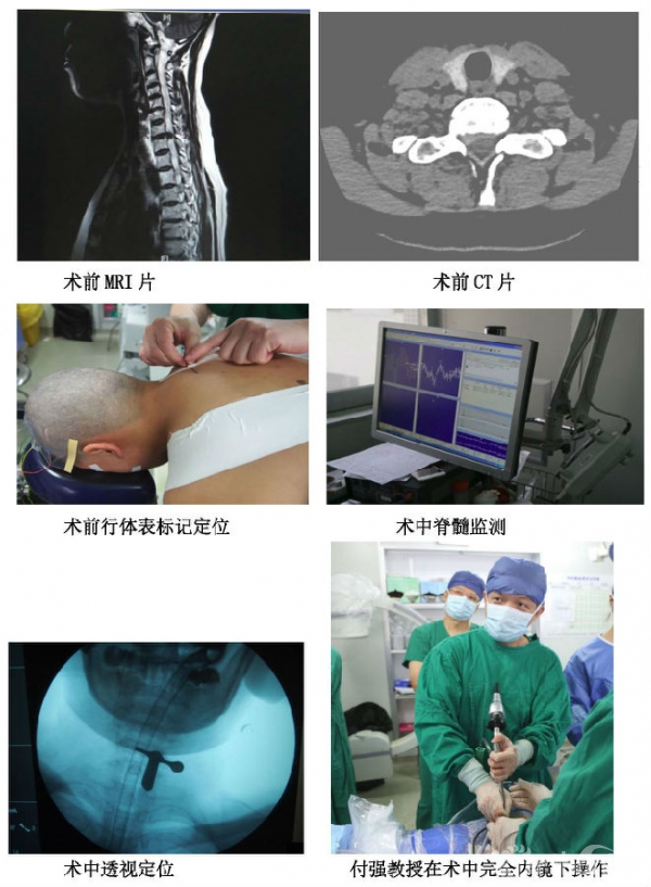 终于成功开展了高难度经皮脊柱内镜下颈椎手术