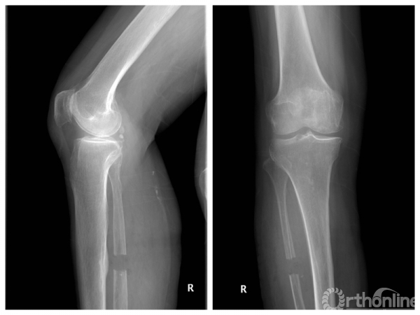 于腓骨小头下方6 ～10 cm 处,截除约2cm长腓骨段,断端用骨蜡封堵,防止