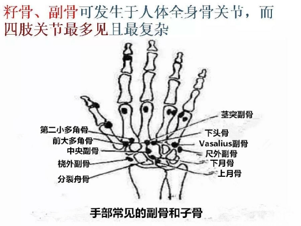 鉴别要点籽骨副骨永存性骨骺以及撕脱性骨折