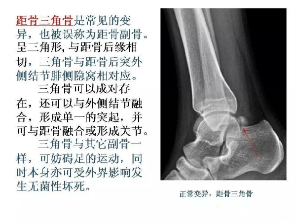 鉴别要点籽骨副骨永存性骨骺以及撕脱性骨折