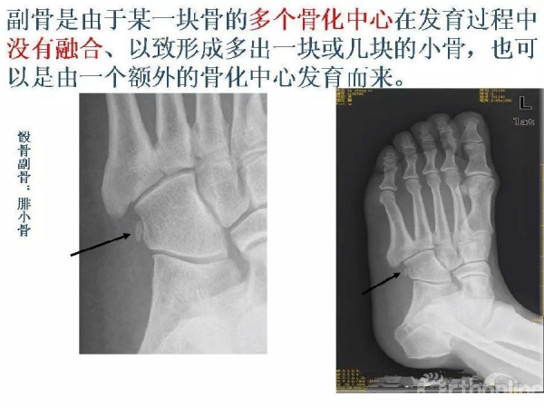 鉴别要点籽骨副骨永存性骨骺以及撕脱性骨折