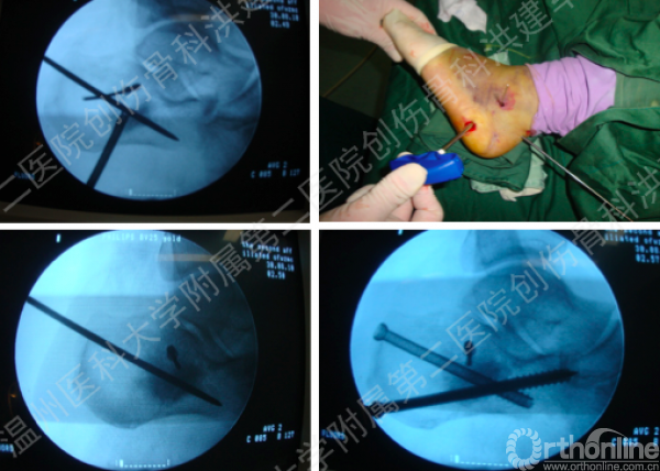 撬拔针和固定针及推顶ct扫描图方案分享病情:跟骨骨折病因:高处坠落伤