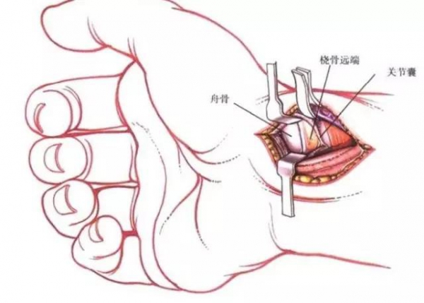 指屈肌腱侧方入路 手指侧方切开线,介于掌背横纹间 不要切开关节囊