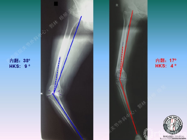 股骨髁上骨折后关节外畸形tka术中股骨内髁滑移截骨