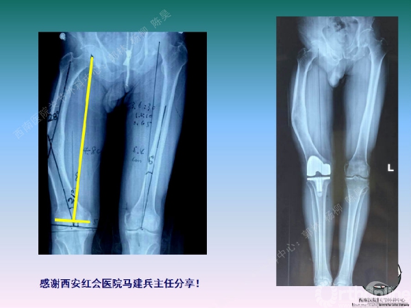 股骨髁上骨折后关节外畸形tka术中股骨内髁滑移截骨