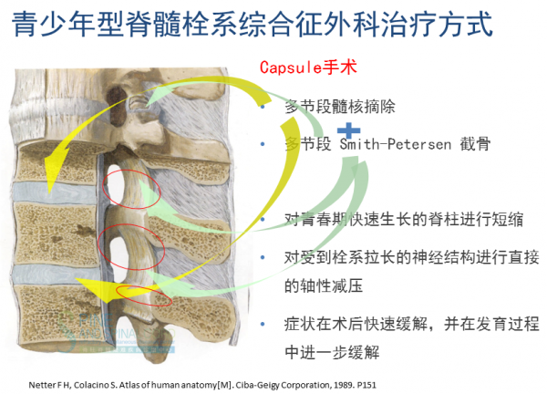 脊髓栓系综合征的发病分期和脊柱外科治疗策略