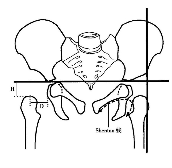 先天性髋关节脱位的x线诊断