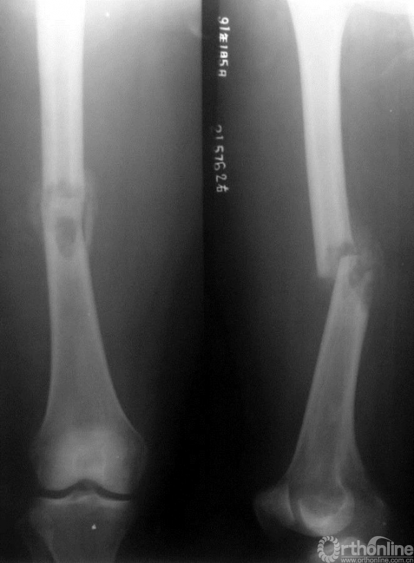 图15-2 伤后1个月x线平片正侧位,骨折端可见骨痂形成