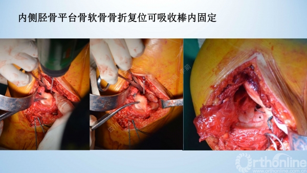 acl胫骨止点撕脱骨折,缝合修复经胫骨隧道固定