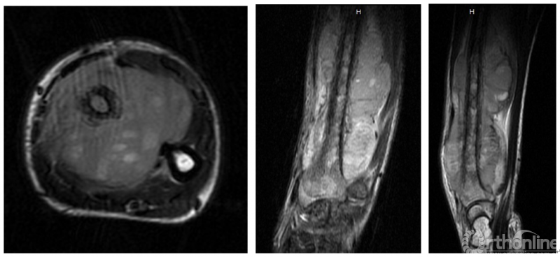 图3.一例桡骨骨干尤文肉瘤的mri表现.