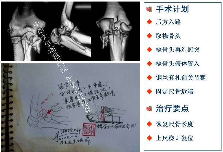 朱勇--复杂肘关节脱位的治疗