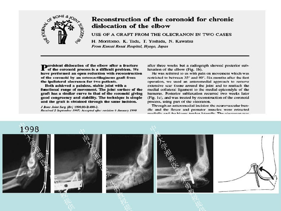朱勇--复杂肘关节脱位的治疗