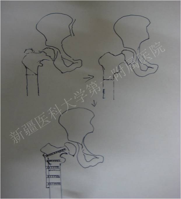 转子间外翻截骨治疗髋关节内翻畸形