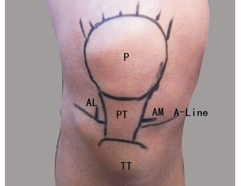 膝关节是由股骨远端,胫骨近端,髌骨共同组成的滑膜关节,与膝关节镜