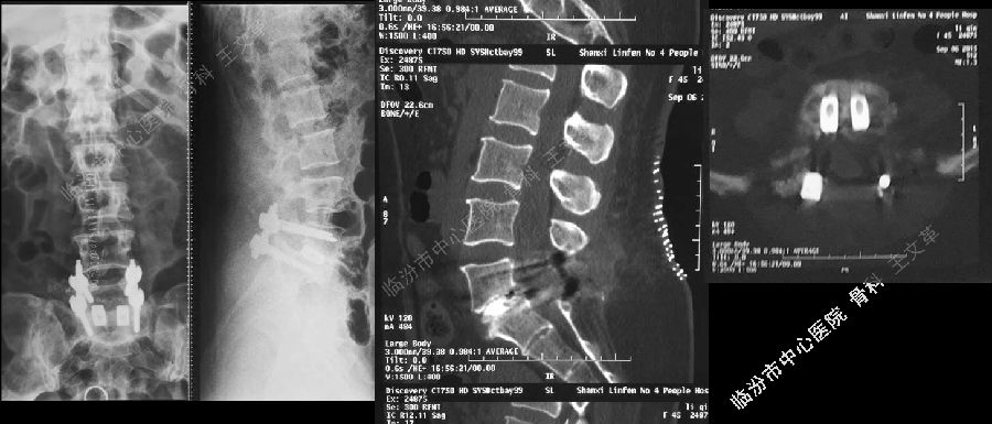 术前x线与腰椎mri 九,病例3 影像学检查 十,经验总结 腰椎滑脱是引起