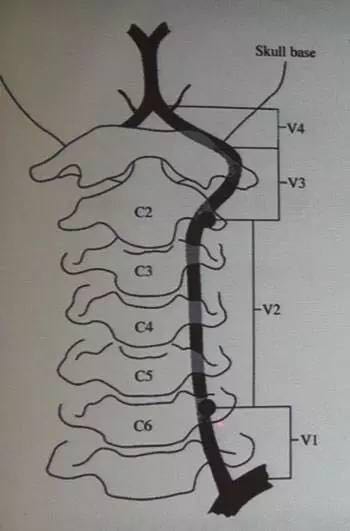 椎动脉脊柱外科医生最头痛的血管