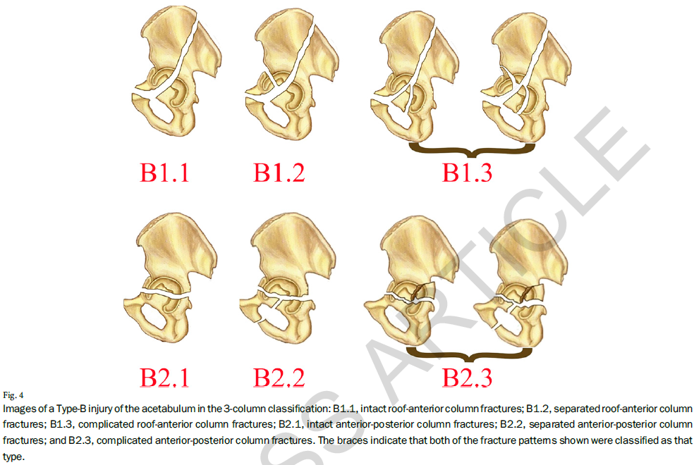髋臼骨折的三柱分型