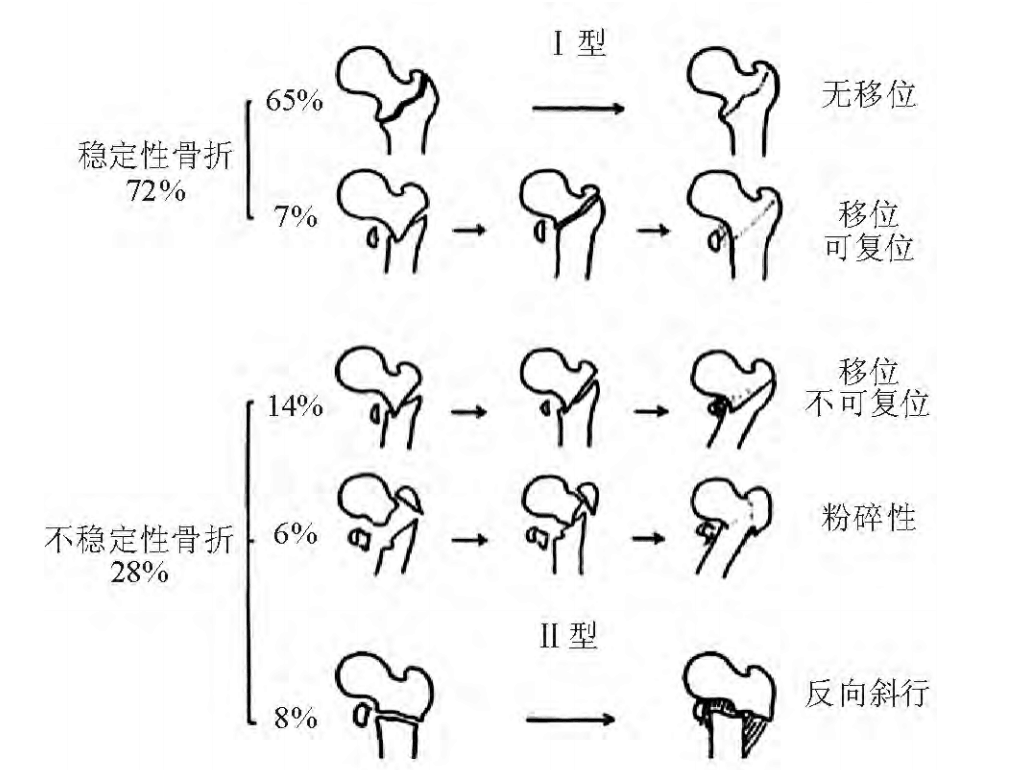 收藏股骨转子间骨折常见分型