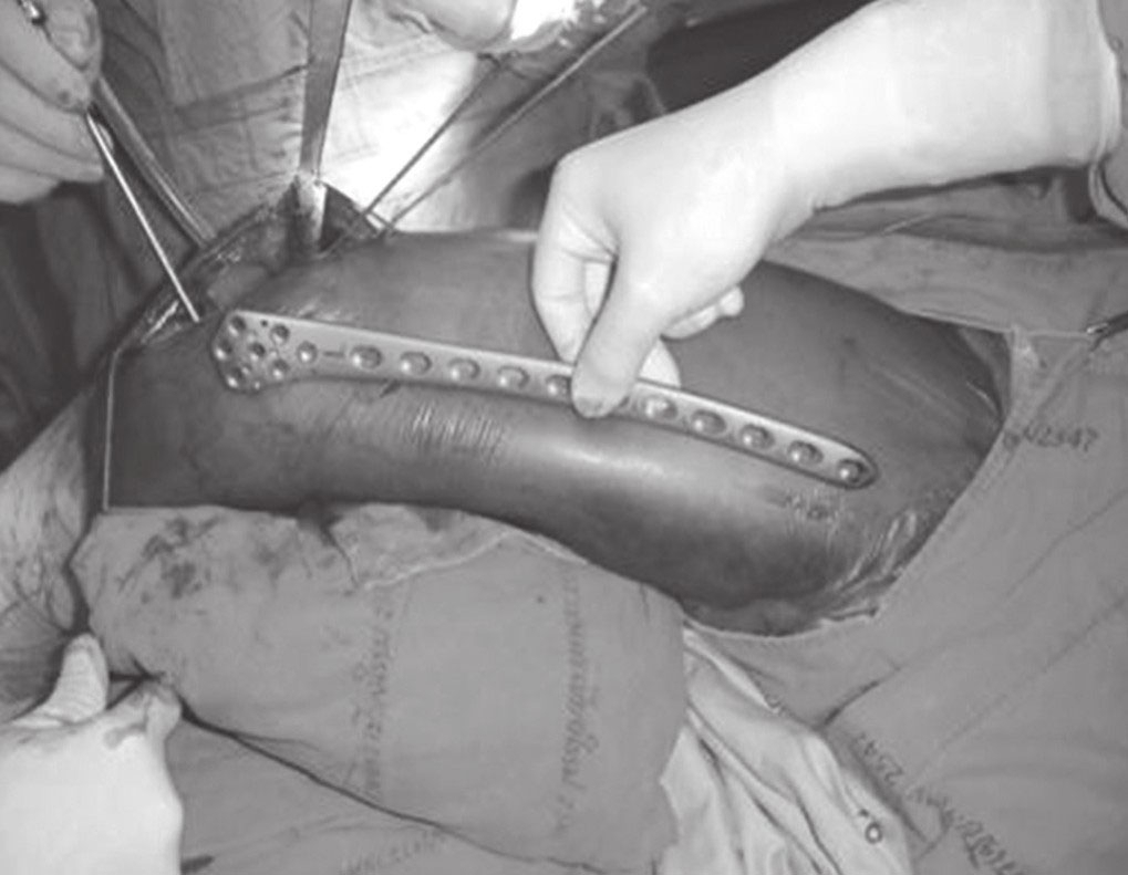手术详解|锁定钢板内固定系统治疗股骨远端骨折