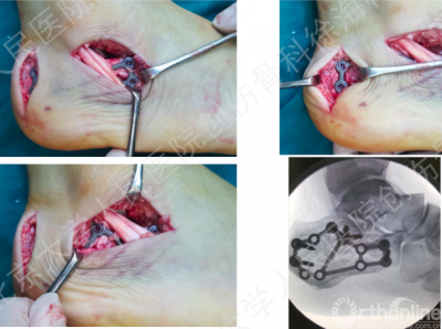 徐海林小切口經皮鋼板植入以及跟骨骨折的微創治療