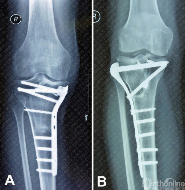 bank selected allograft inpatient with right proximal tibial