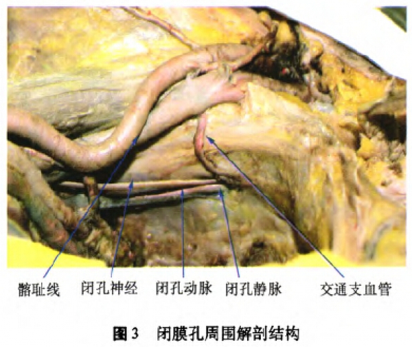 2髂耻线周围重要结构的解剖特点:闭孔神经起自腰丛,在真骨盆上缘处由