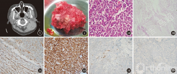 颅内骨外尤文肉瘤1例报道