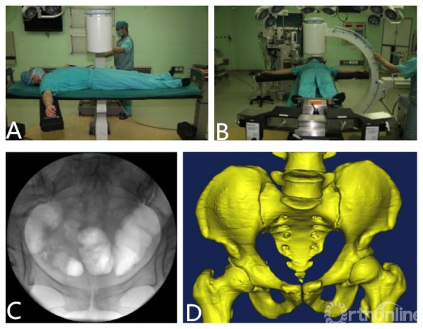 骨盆髖臼微創治療關鍵技術如何讀懂術中透視影像