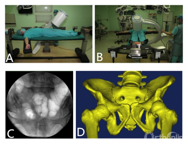 骨盆髖臼微創治療關鍵技術如何讀懂術中透視影像
