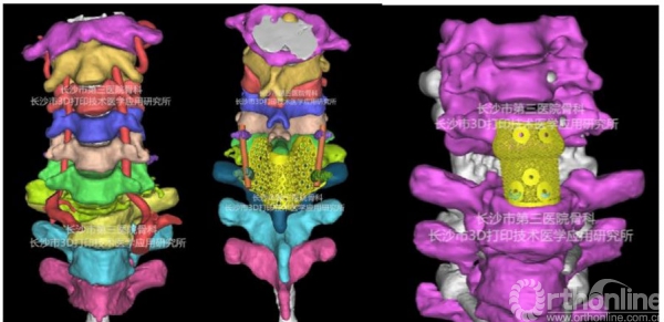 金屬3d打印全脊椎在頸椎7惡性腫瘤中的應用研究