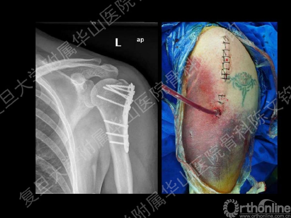 入路也可用於肱骨外科頸骨折肱骨大結節骨折是最佳適應症切口長度有限
