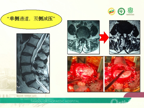 mistlif治療腰椎滑脫症的策略及併發症