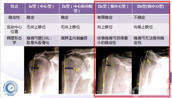 肩關節置換和肩袖功能重建