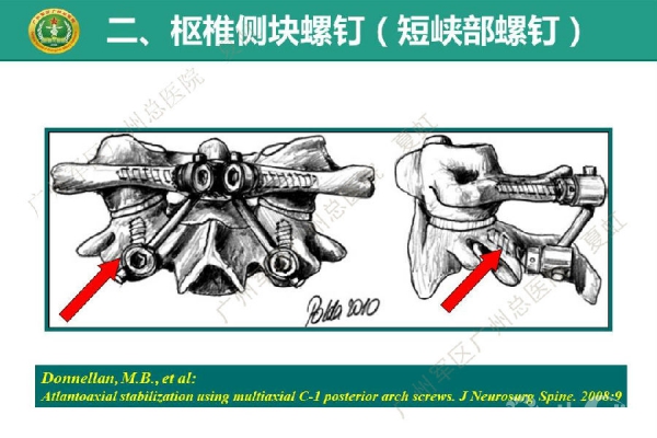 颈椎侧块螺钉图片图片