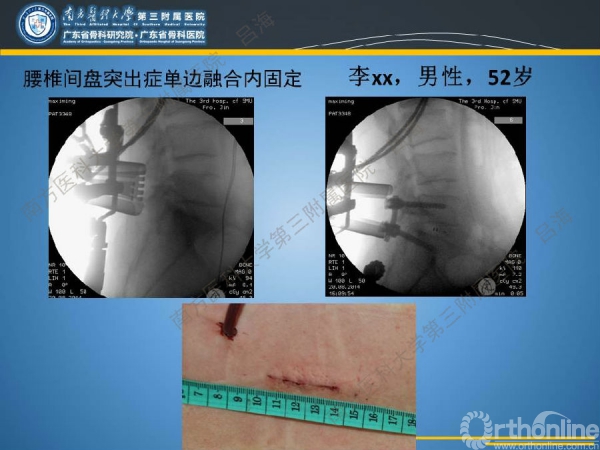 mistlif在治療胸腰椎退行性病變中的應用