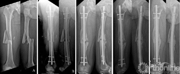 股骨幹骨不連的雙鋼板治療