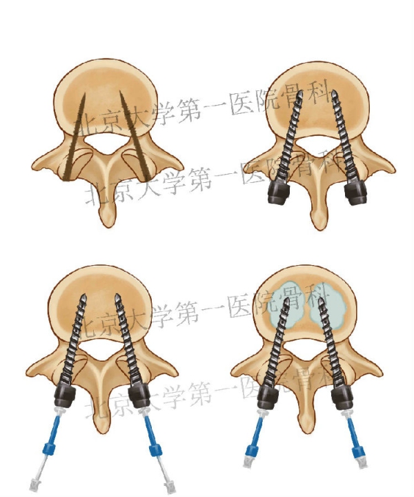 椎弓根螺钉技术图片