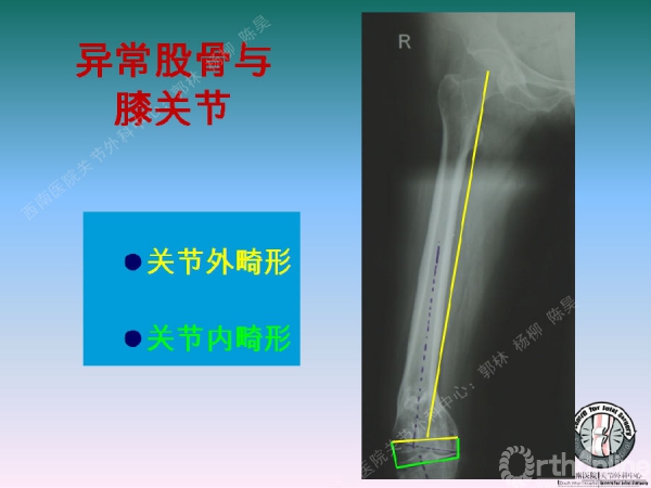 股骨髁上骨折後關節外畸形tka術中股骨內髁滑移截骨