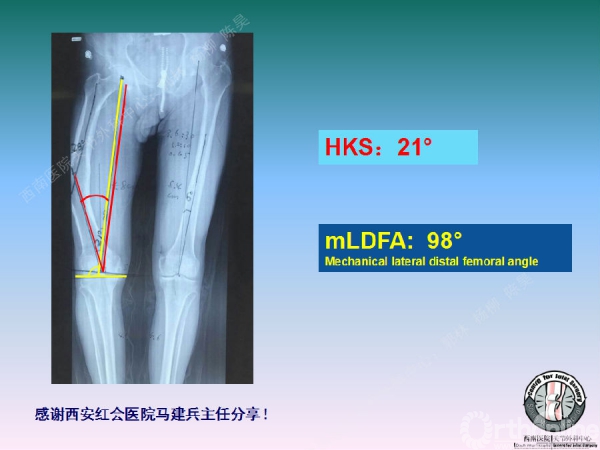 股骨髁上骨折後關節外畸形tka術中股骨內髁滑移截骨