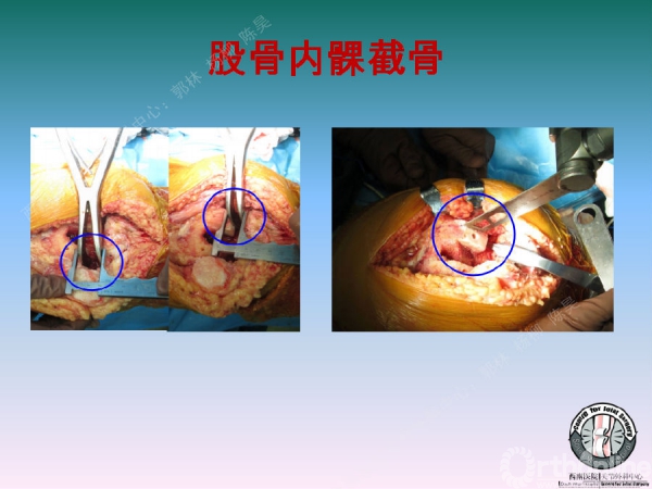 股骨髁上骨折後關節外畸形tka術中股骨內髁滑移截骨