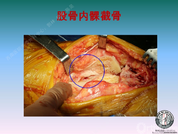 股骨髁上骨折後關節外畸形tka術中股骨內髁滑移截骨