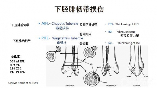 下胫腓韧带图片