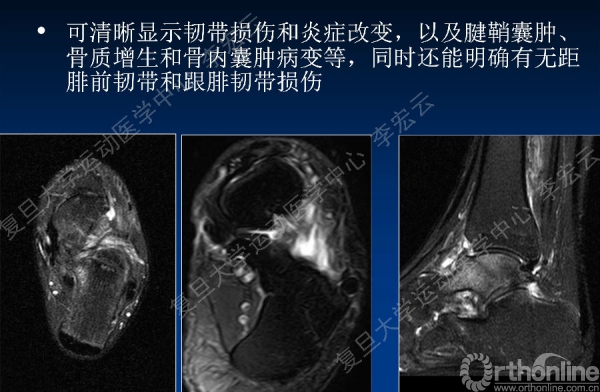 跗骨窦综合征