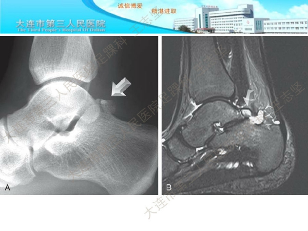 關節鏡治療距骨後三角骨綜合徵