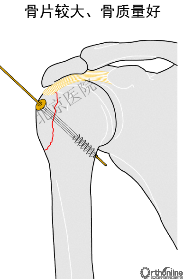 漫谈肱骨大结节骨折治疗策略
