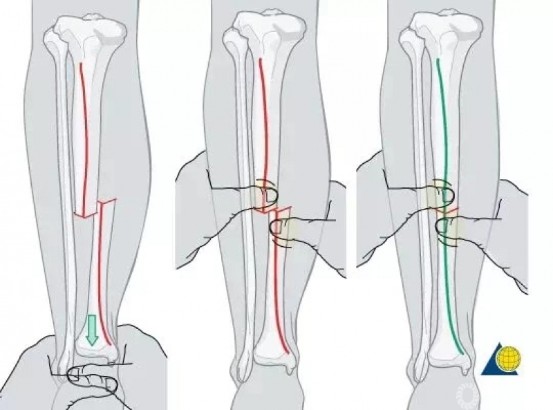 横行的骨折可以通过复位后较好的呆在复位后的位置,手指触摸胫骨前方