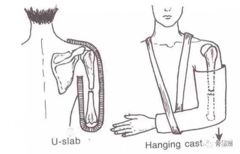 桡骨骨折石膏固定步骤图片