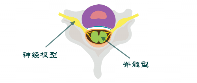 包括椎間盤(髓核和纖維環),椎體的軟骨終板,前縱韌帶和後縱韌帶,鉤椎