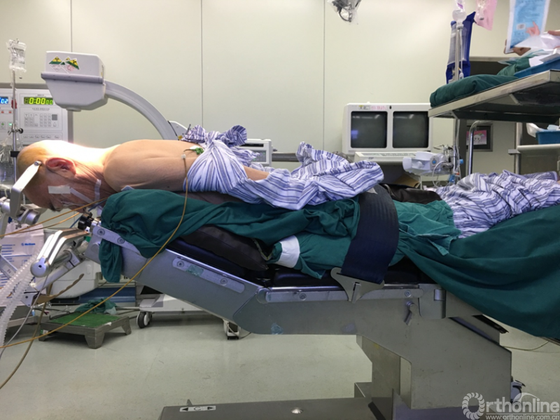 手术视频详解:颈后路单开门椎管扩大成形术